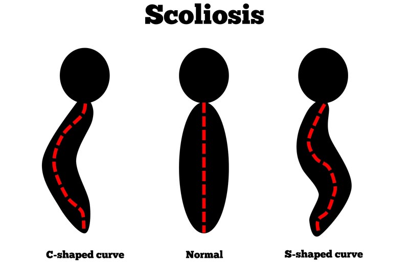 Lincoln, NE scoliosis treatment